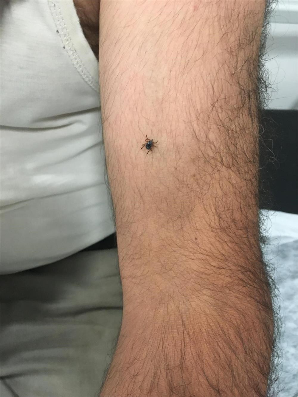 Kayseri’nin bir ilçesinde daha kene vakası Kayseri’nin bir ilçesinde daha kene vakası